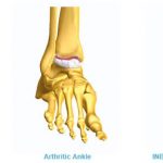 arthritis