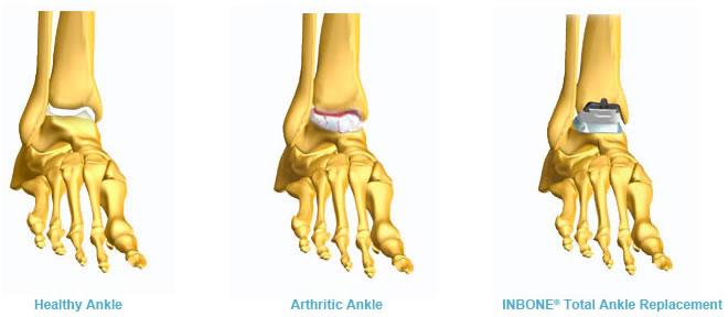 arthritis