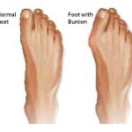 bunions