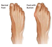 bunions